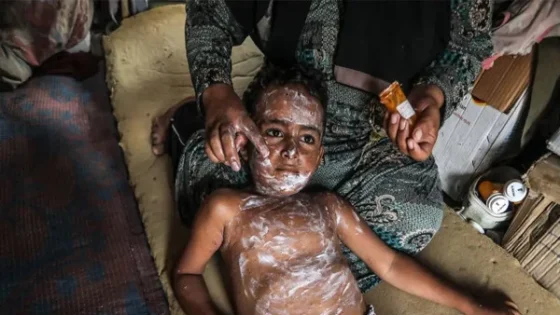 غزہ میں بے گھر فلسطینی بچوں میں چکن پاکس کے کیسز میں مسلسل اضافہ
