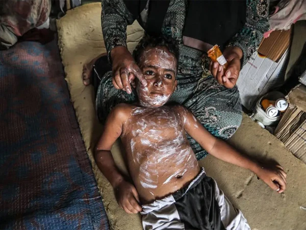 غزہ میں بے گھر فلسطینی بچوں میں چکن پاکس کے کیسز میں مسلسل اضافہ